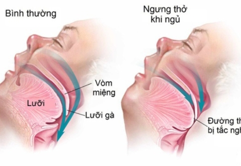 Béo phì và biến chứng ngừng thở khi ngủ